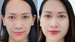The Truth About Autologous Fat Grafting: Does It Last Permanently?