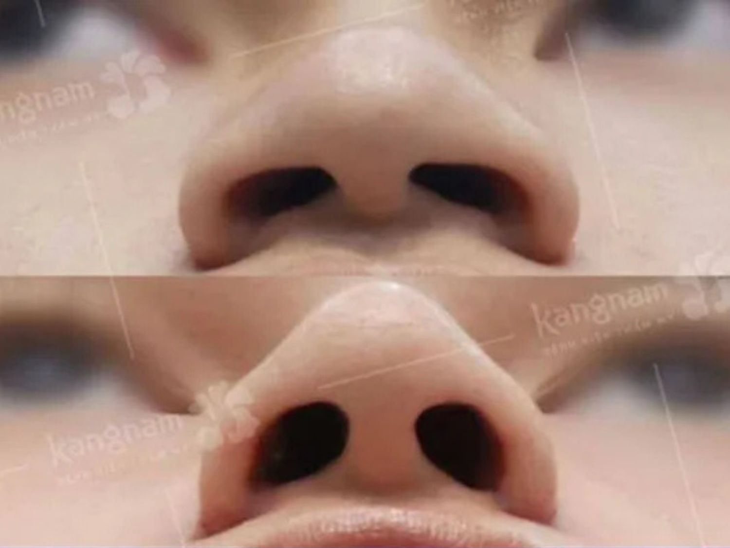 The results of the surgery are permanent. 