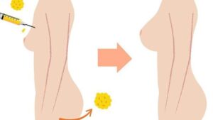 Autologous Fat Transfer Breast Augmentation: A Fast Recovery Solution for Overseas Vietnamese