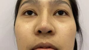 Can a Crooked Nose After Rhinoplasty Be Manually Adjusted? 3 Cases Where Alignment Is Possible