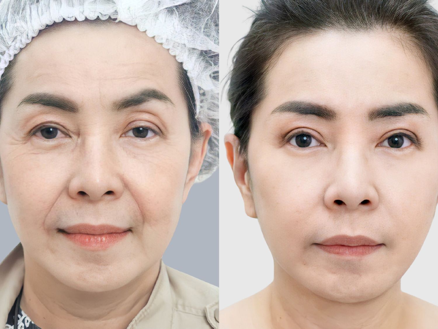 Phẫu thuật căng da mặt giúp khuôn mặt trông trẻ trung, săn chắc và mịn màng hơn.