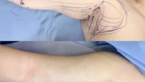 How Long Does Arm Liposuction Take to Heal? How to Care for Your Arms for a Fast Recovery