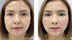 How Long Does Collagen Thread Lifting Take to Heal? Expert Insights