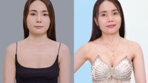 How Much Does Breast Augmentation Cost in Vietnam? 2026 Updated Price List