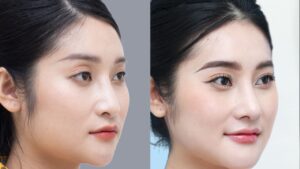 How Much Does Jaw Reduction Surgery Cost? Latest Price Guide