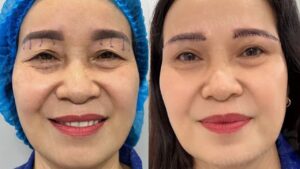 How much does an eyebrow lift cost? Latest price list