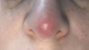 How long does it take for nasal tip redness to fade after a nose job? 5 signs of abnormal redness.