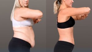 Is Liposuction at Kangnam Expensive? Complete Pricing & Investment Guide