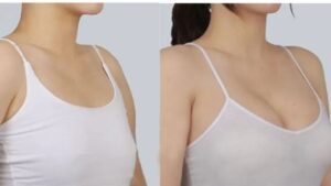 Non-Surgical Breast Augmentation: Pros and Cons Women Need to Know