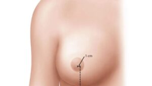 Periareolar Breast Augmentation: Pros, Cons, and Key Things to Know