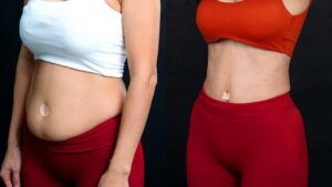 Top Reputable Liposuction Centers in Ho Chi Minh City Highly Rated by Clients