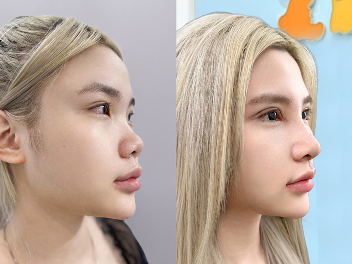 The rhinoplasty results ensure safety and high aesthetic appeal. 