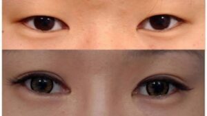 What Is a Double Eyelid? How to Identify It & Quick Ways to Achieve It