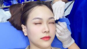 When Are Eyelid Sutures Removed After Blepharoplasty? Recovery Stages & Aftercare Guide
