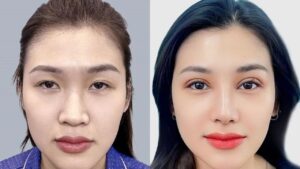 Where to Get Beautiful Eyelid Surgery in Hanoi? Top High-Quality Eyelid Surgery Destinations