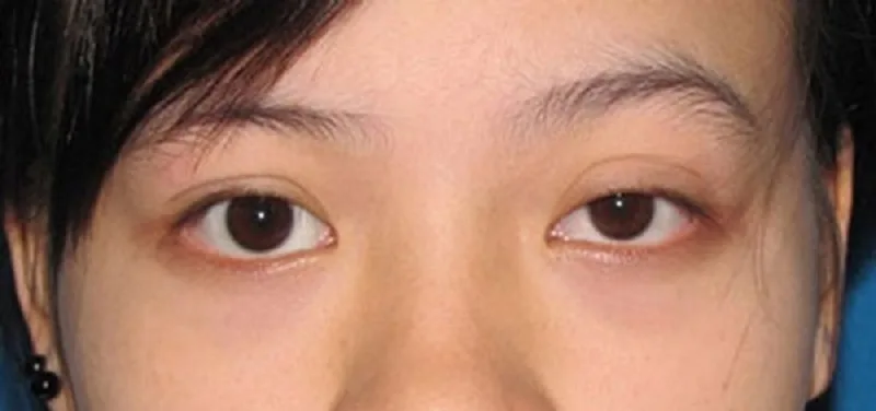 Eyelid surgery at a non-reputable address causes uneven eyelids