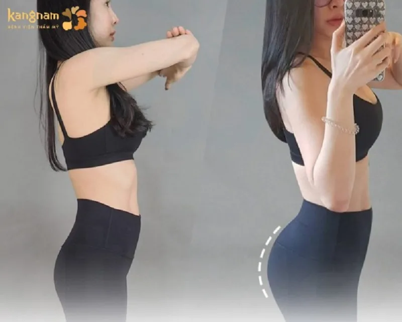 The results of buttock fat grafting are relatively long-lasting. 