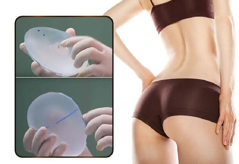 Buttock augmentation with implants offers long-lasting results. 