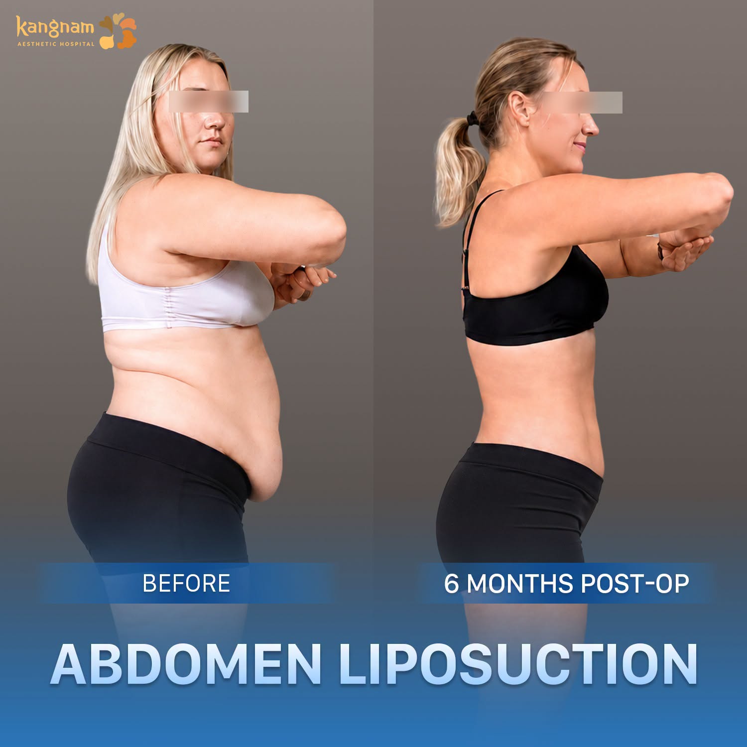 Confidently flaunt alluring curves and a well-defined silhouette after fat reduction at Kangnam. 