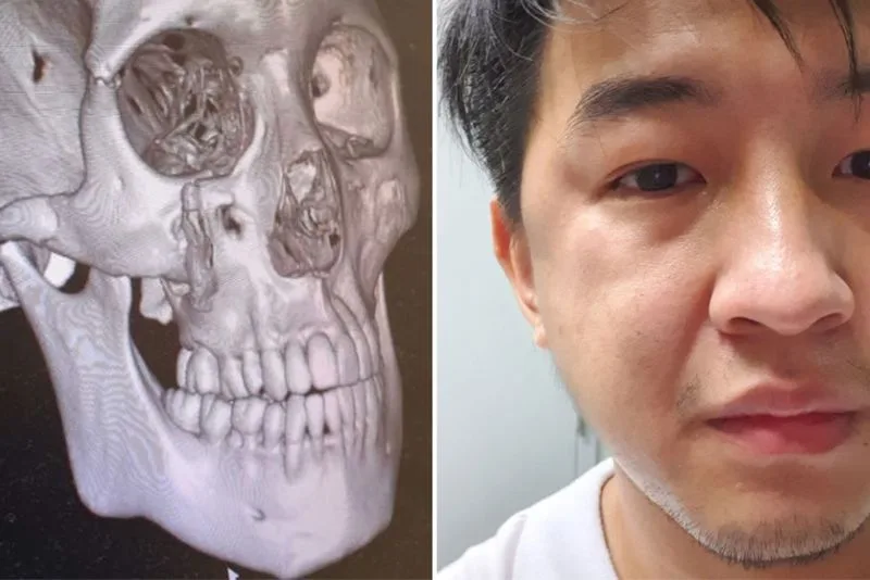 A fractured cheekbone heals in 6–8 weeks. 