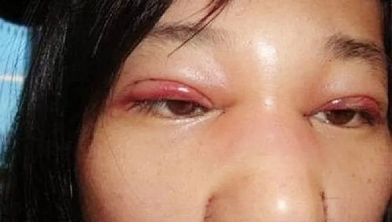 The eyelids remain severely swollen, showing no improvement after one month. 