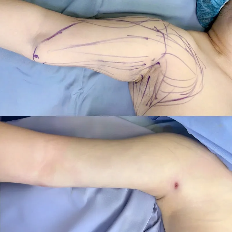 When first undergoing arm liposuction, the wound will be slightly swollen and bruised