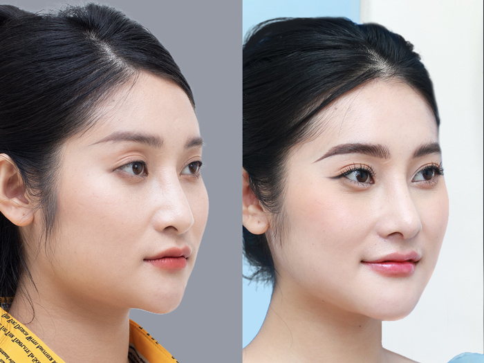 The cost of jaw reduction surgery depends on the client's condition. 