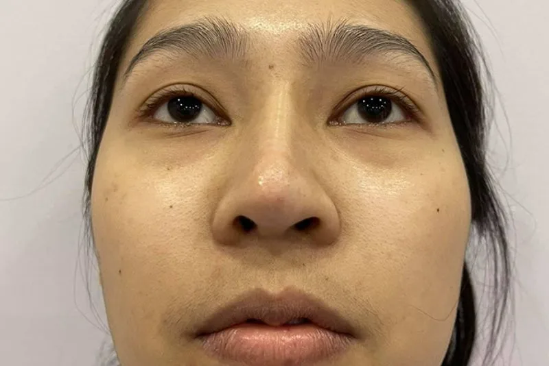 Crooked nose due to thin nasal skin tissue