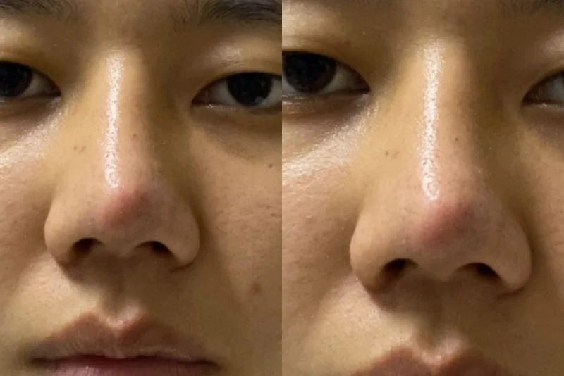 Crooked nose due to cartilage displacement