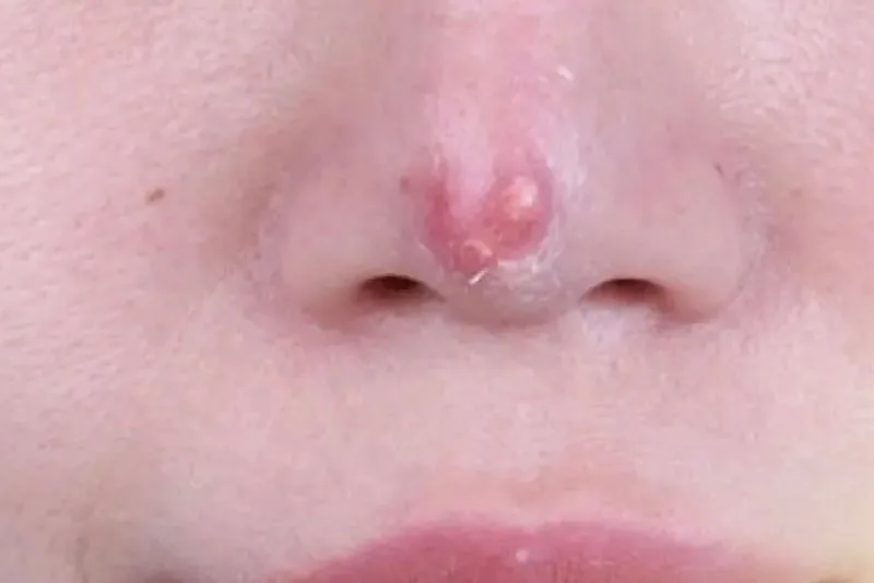 Nasal tip redness due to cartilage reaction