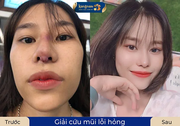 Reconstructing a crooked and twisted nose caused by infection, the client possesses a balanced nose shape