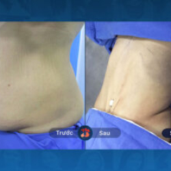 VASER 4D LIPOSUCTION: SAFETY – EFFICIENT – SAVE