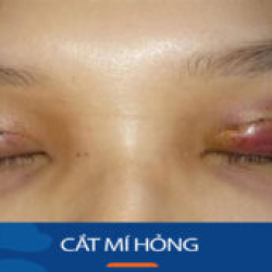 Cắt mí hỏng: Cách nhận biết và hướng khắc cho việt kiều về nước