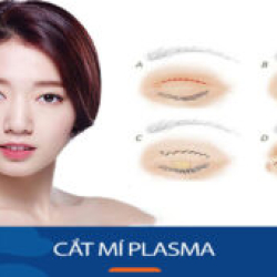 Cắt mí plasma cho KH việt kiều- Công nghệ đánh thức vẻ đẹp tự nhiên