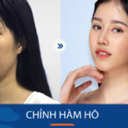 Cận cảnh Chỉnh hàm hô cho khách hàng Việt Kiều tại BV Kangnam