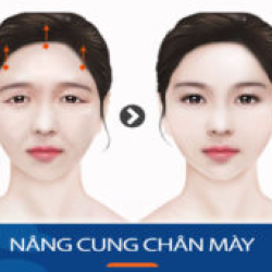 Khách hàng Việt Kiều Nâng cung chân mày tại BV Kangnam