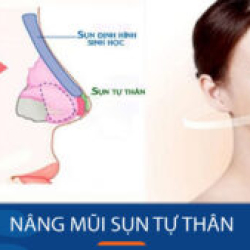 Nâng mũi sụn tự thân: Kiến thức nâng cao cho KH việt kiều