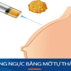 Nâng ngực bằng mỡ tự thân giải pháp hồi phục nhanh cho Việt Kiều