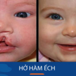 Phẩu thuật Hở hàm ếch cho khách hàng Việt Kiều