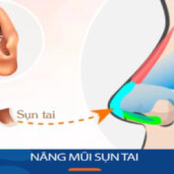 Địa chỉ Nâng mũi sụn tai cho KH Việt Kiều về nước