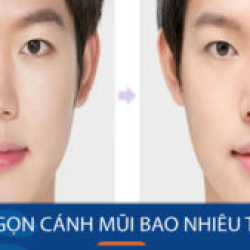 Thu gọn cánh mũi bao nhiêu tiền? 3 yếu tố quyết định chi phí