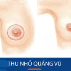 Địa chỉ Thu nhỏ quầng vú dành cho Khách hàng Việt Kiều về nước