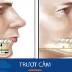 Case Trượt cằm xuất sắc của Khách hàng Việt Kiều về nước