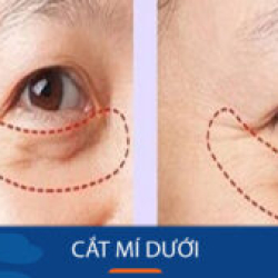 Cắt mí dưới – Trẻ hóa vùng mắt dưới thanh tú, tự nhiên