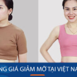 Bảng giá giảm mỡ tại Việt Nam – Duy nhất Tại BV thẩm mỹ kangnam