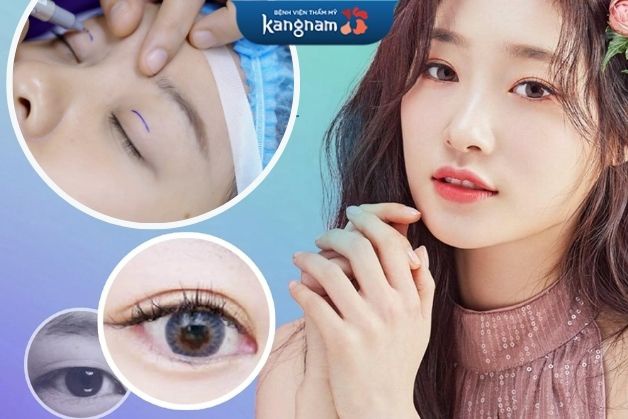 Cắt mí Perfect Eyes có nhiều điểm vượt trội