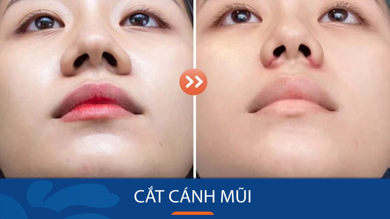 Cận cảnh Cắt cánh mũi cho KH việt kiều tại BV kangnam