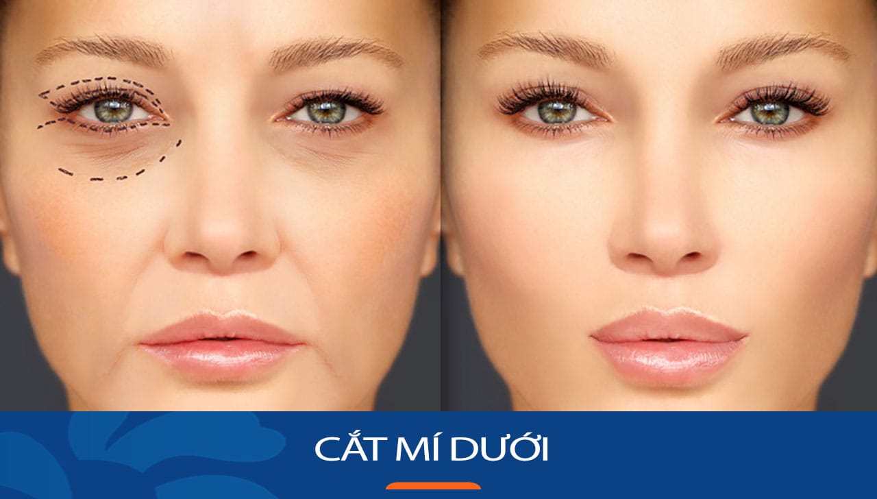 Cắt mí dưới : Bí quyết làm đẹp cho việt kiều về nước