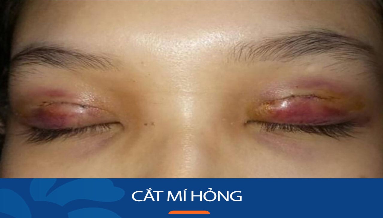 Cắt mí hỏng: Cách nhận biết và hướng khắc cho việt kiều về nước