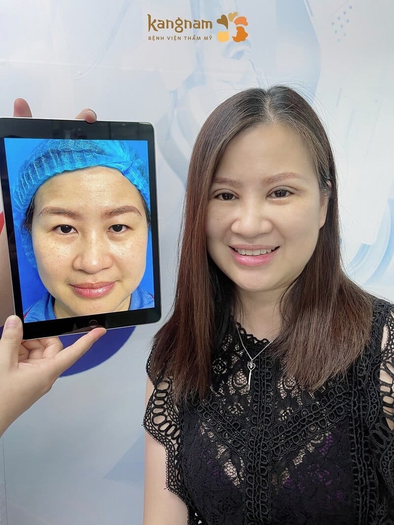 Sở hữu mắt hai mí cân đối, rõ nét chỉ sau 7 ngày cắt mí 6D